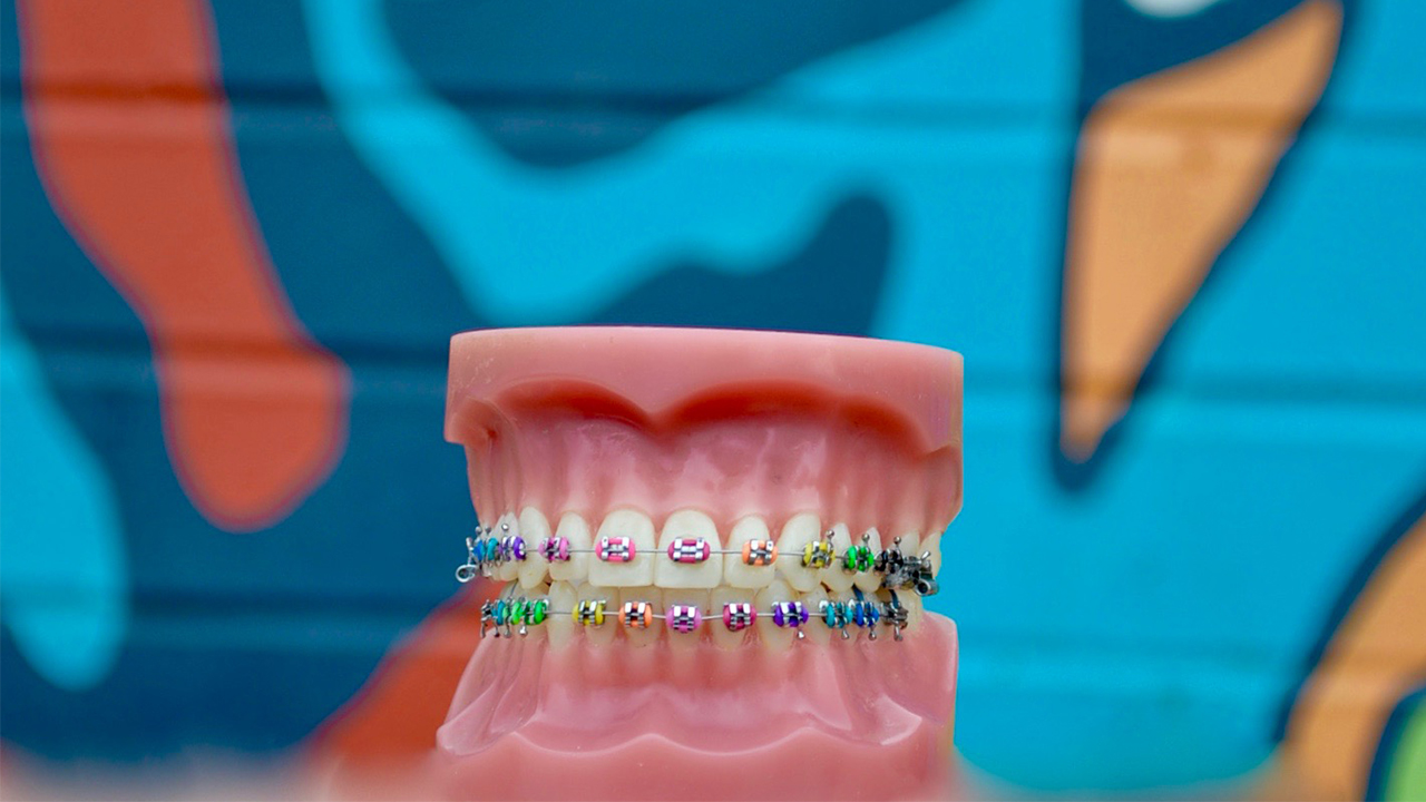 Dental braces on top and lower arches