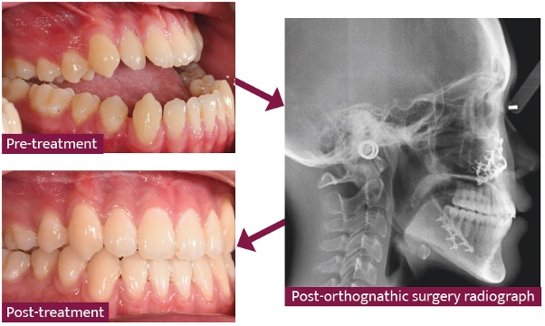 pre-treatment oral surgery and post-orthognathic surgery radiograph