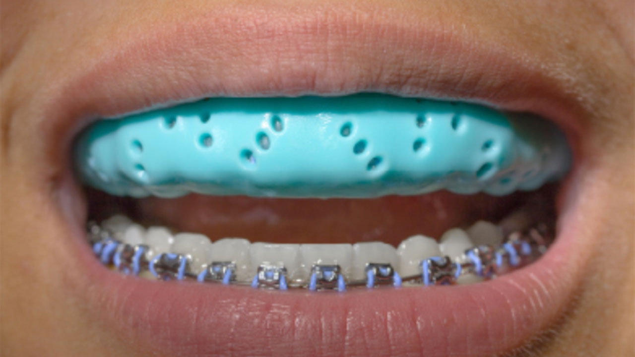 Dental mouthguard