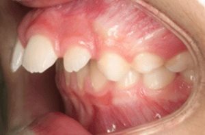 Affects of thumb sucking to avoid overbite