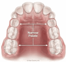 The narrow palate of a child's jaw and thumb sucking