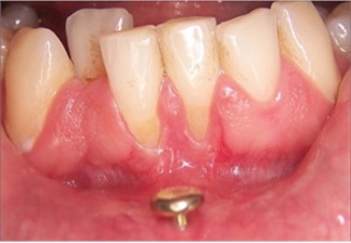 Labret piercing and dental infection control 