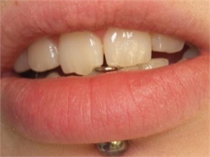 Lip piercing and chipped teeth risks