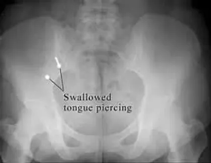 x-ray of swallowed tongue piercing